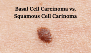 Basal Cell Carcinoma Vs Squamous Cell Carcinoma Vujevich Dermatology