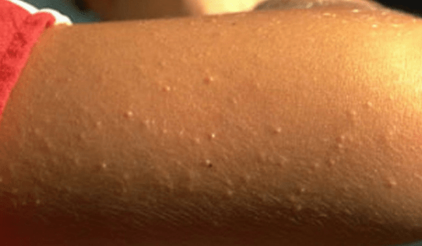 red itchy bumps on forearm