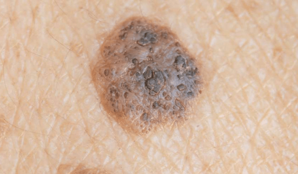 Seborrheic Keratosis Vs Skin Cancer Hot Sex Picture