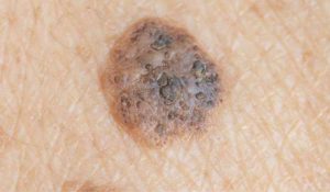 Seborrheic Keratosis vs. Melanoma | Vujevich Dermatology Associates