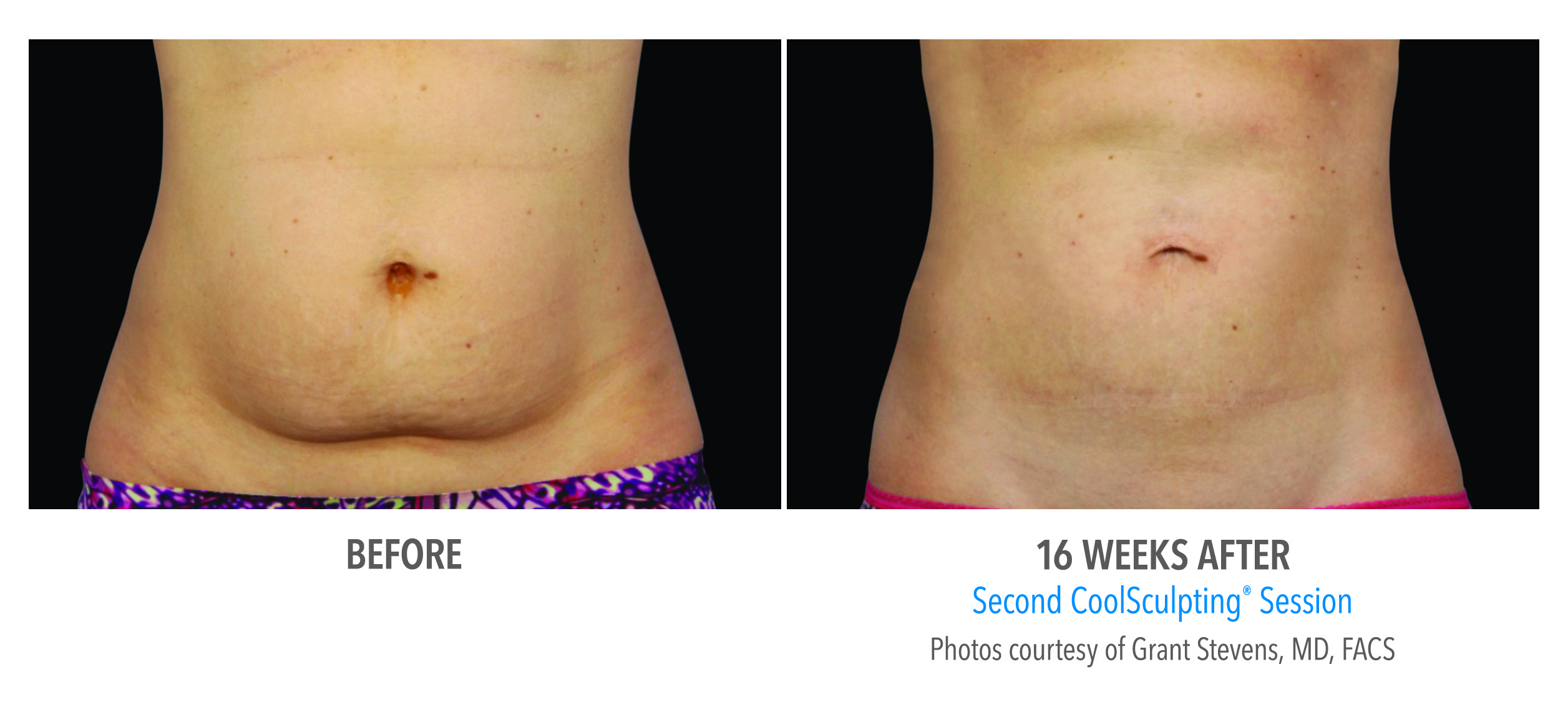 coolsculpting® Pittsburgh - before and after