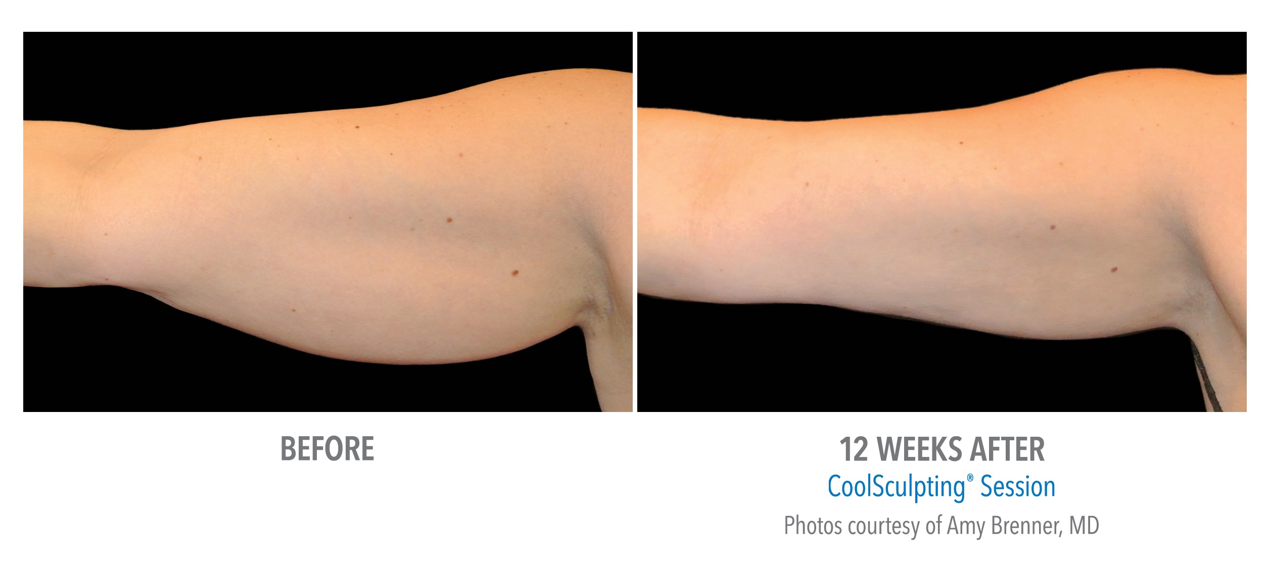 coolsculpting® pittsburgh before and after