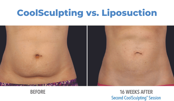 Coolsculpting before and after pictures - Laser & Cosmetic Surgery  Specialist