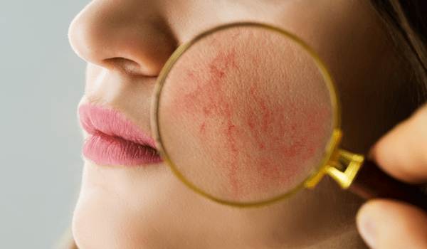 3 Reasons For Red Patches On Your Face Vujevich Dermatology