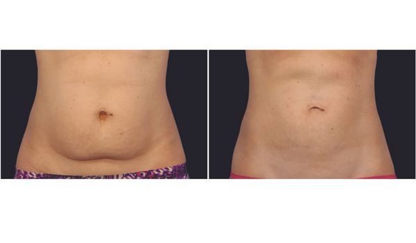 Non Surgical Fat Removal From Stomach Blog 600x350 1 