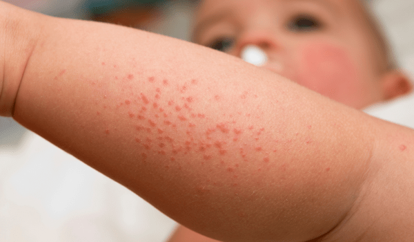 toddler allergy rash