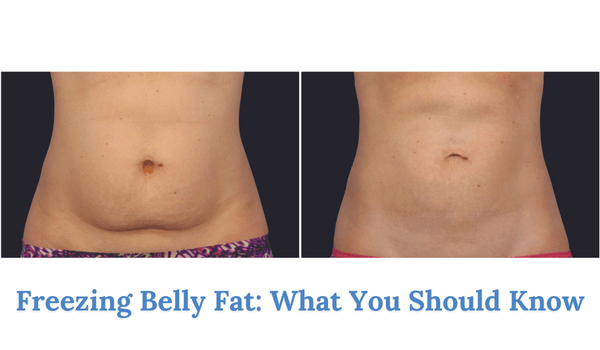 Coolsculpting, Fat Reduction & Cell Removal