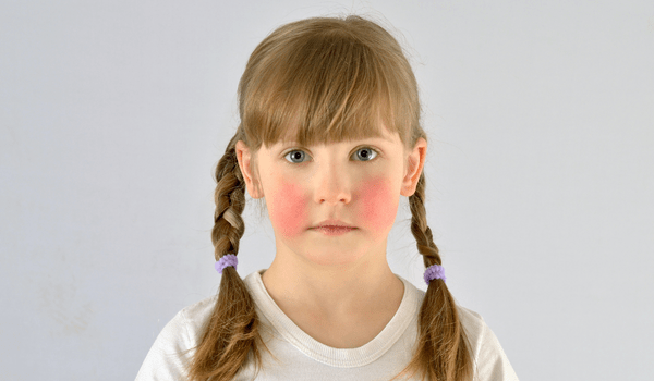 What Causes Red Cheeks In A Child Vujevich Dermatology