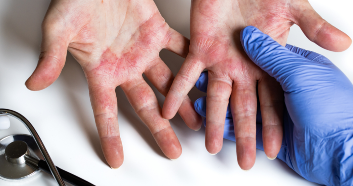 atopic dermatitis vs eczema