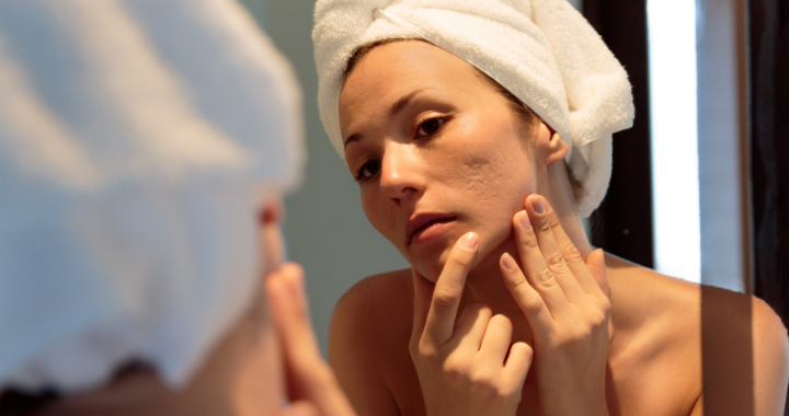 chemical peels for acne scars