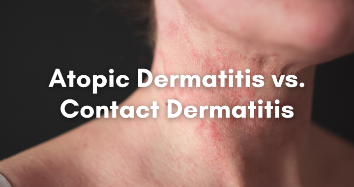 atopic dermatitis vs contact dermatitis