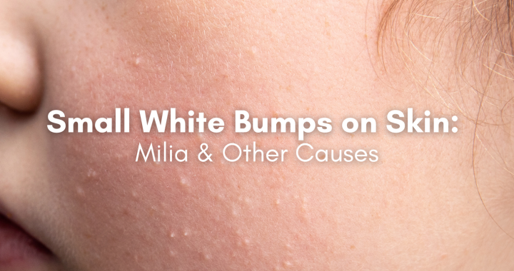 small white bumps on skin